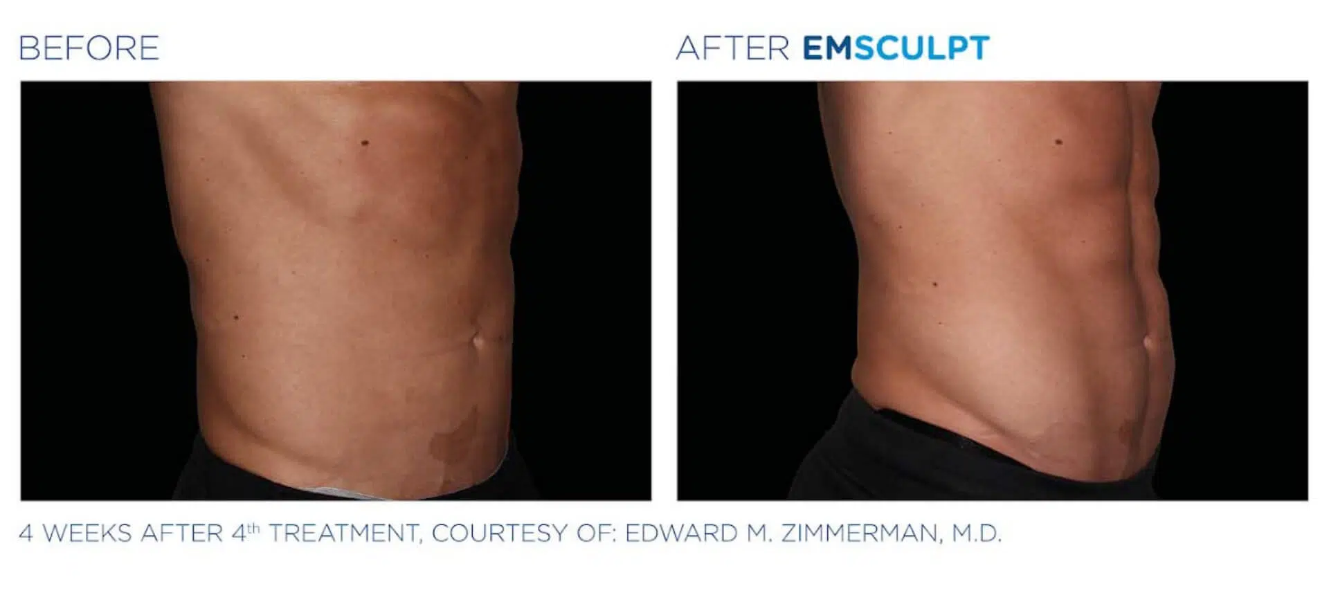 emsculpt_mens_ab