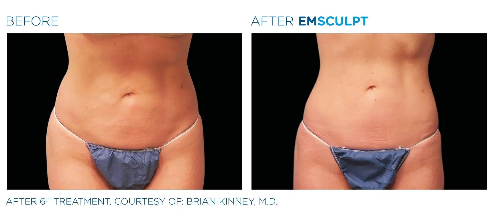 emsculpt_pic_ba-card-female-abdomen-031_enus100