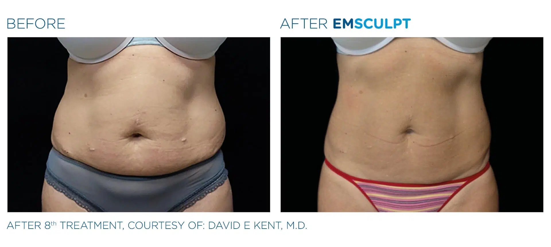 emsculpt_pic_ba-card-female-abdomen-034_enus100