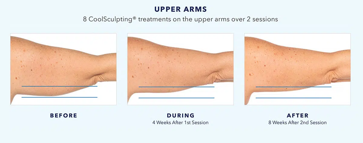 coolsculpting-before-and-after-upper-arms