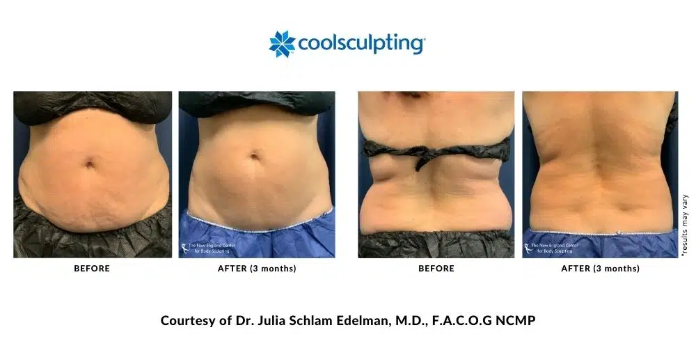 439654445-julia-edelman-before-and-after-mobile-9 439654445-julia-edelman-before-and-after-mobile-9