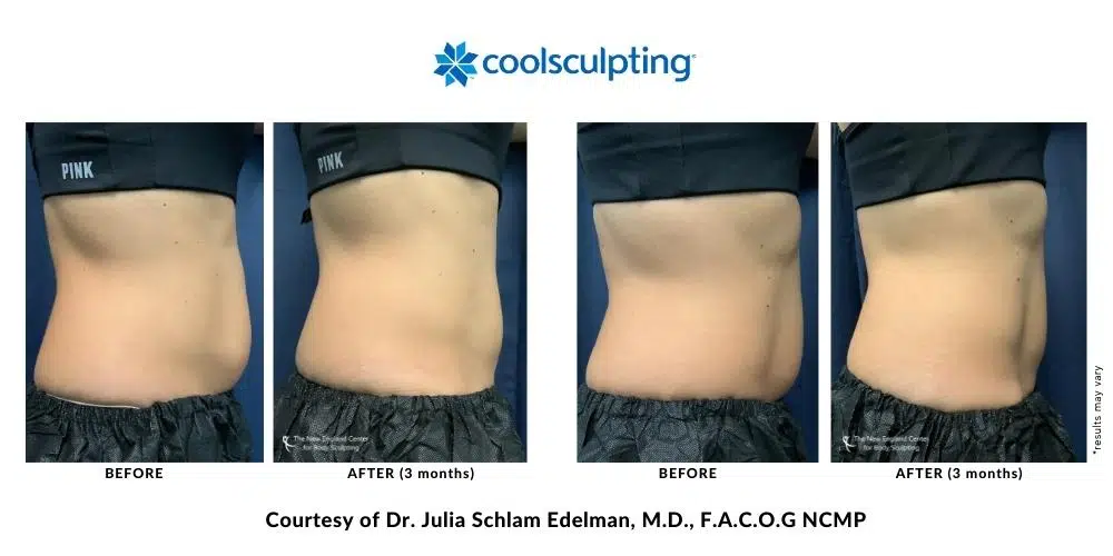 439654454-julia-edelman-before-and-after-mobile-8 439654454-julia-edelman-before-and-after-mobile-8
