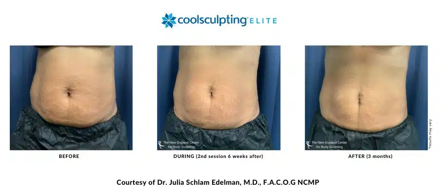 julia-edelman-coolsculpting-elite-before-and-after-image-desktop julia-edelman-coolsculpting-elite-before-and-after-image-desktop