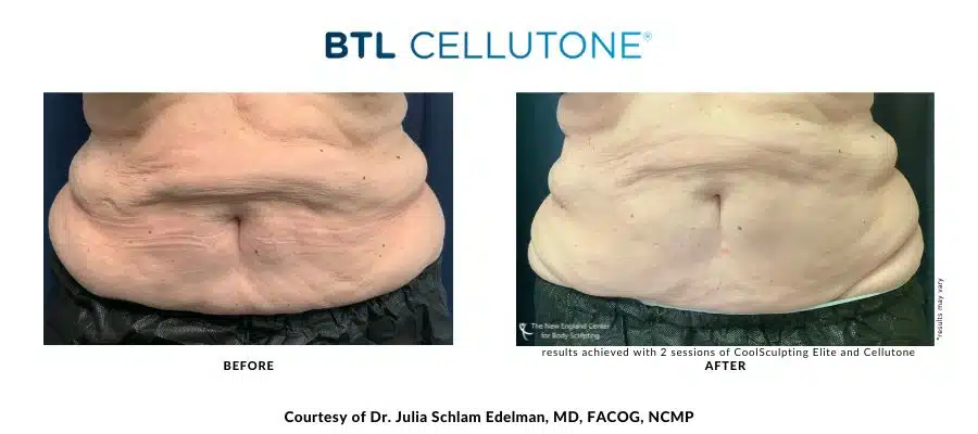 cellutone-before-and-after-dr.-edelman Actual CoolSculpting Elite and Cellutone before and after treatment images by Dr. Julia Edelman