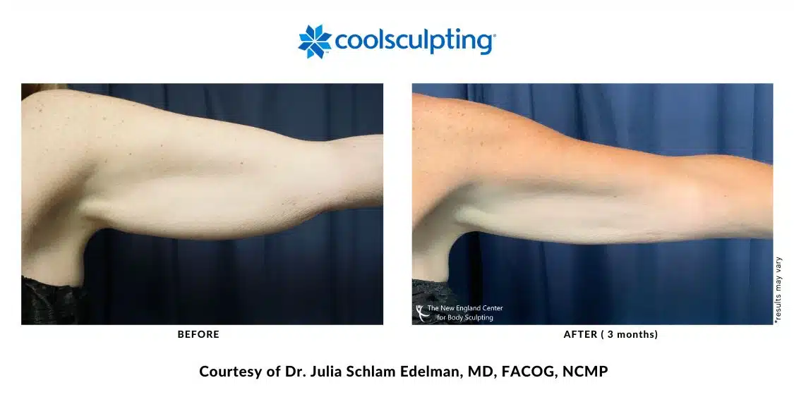 Actual CoolSculpting Elite arm area before and after treatment by Dr. Edelman in Middleboro, MA