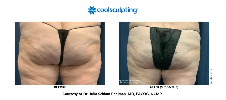 Outer thighs treated with CoolSculpting Elite by Dr. Julia Edelman in Middleboro, Massachusetts, before and after