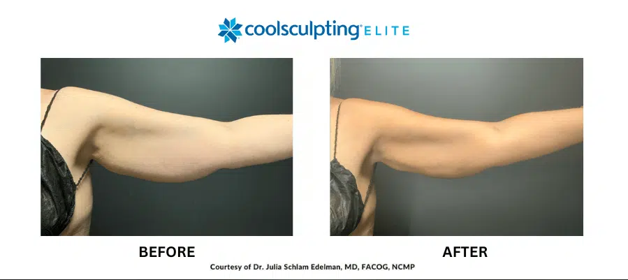 coolsculpting-elite-ba-2 coolsculpting-elite-ba-2