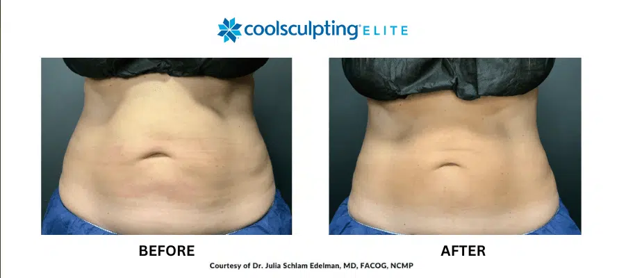 coolsculpting-elite-ba-3 coolsculpting-elite-ba-3