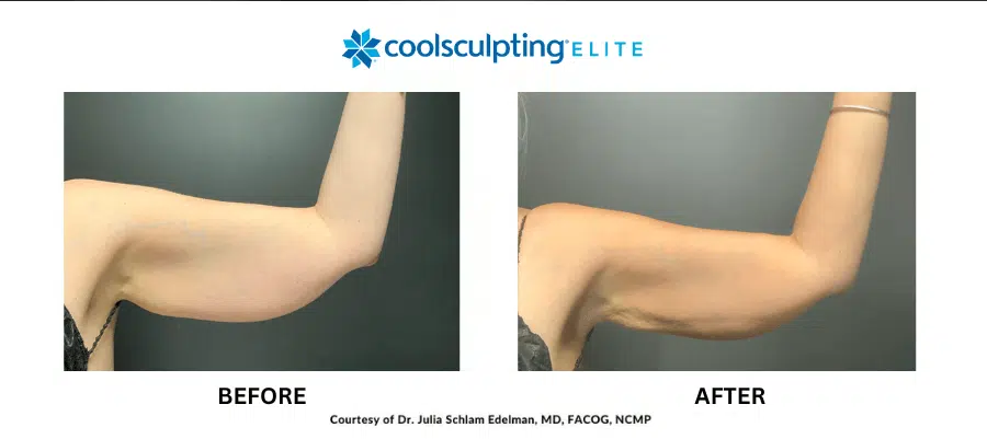 coolsculpting-elite-ba-4 coolsculpting-elite-ba-4