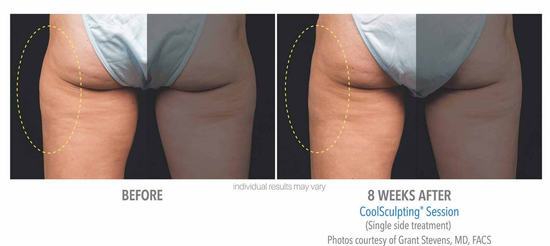 coolsculpting-before-and-after-photos_3 coolsculpting-before-and-after-photos_3