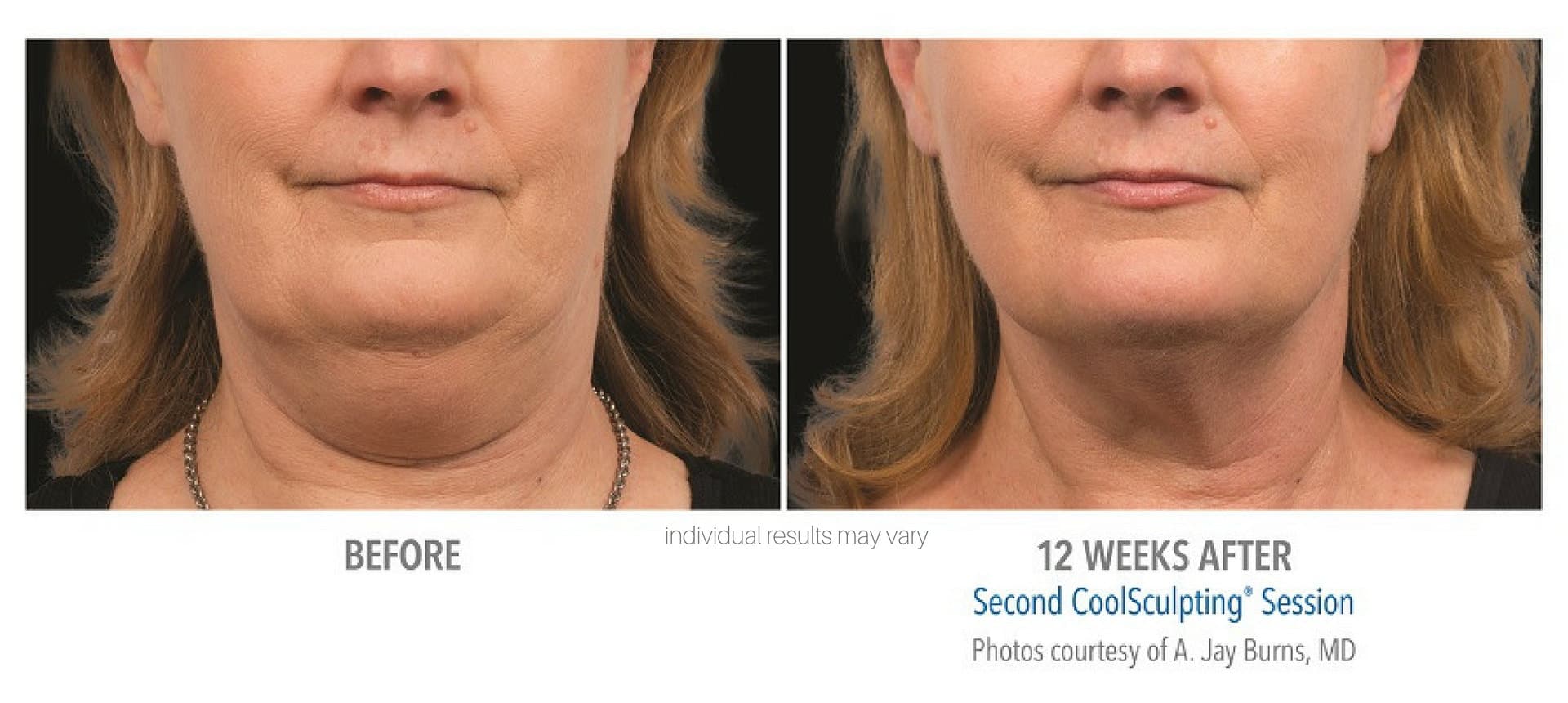 coolsculpting-before-and-after-photos_4 coolsculpting-before-and-after-photos_4