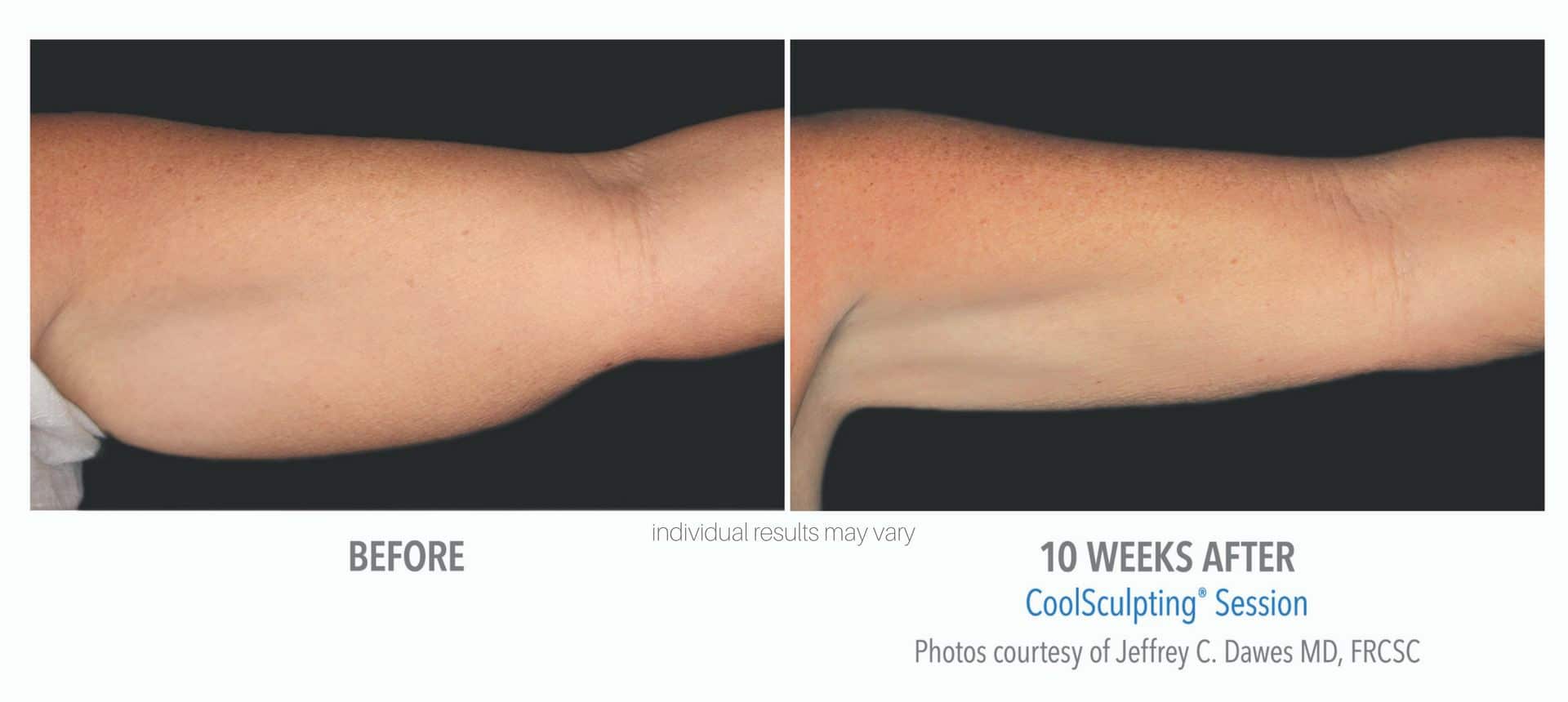 coolsculpting-before-and-after-photos_5 coolsculpting-before-and-after-photos_5