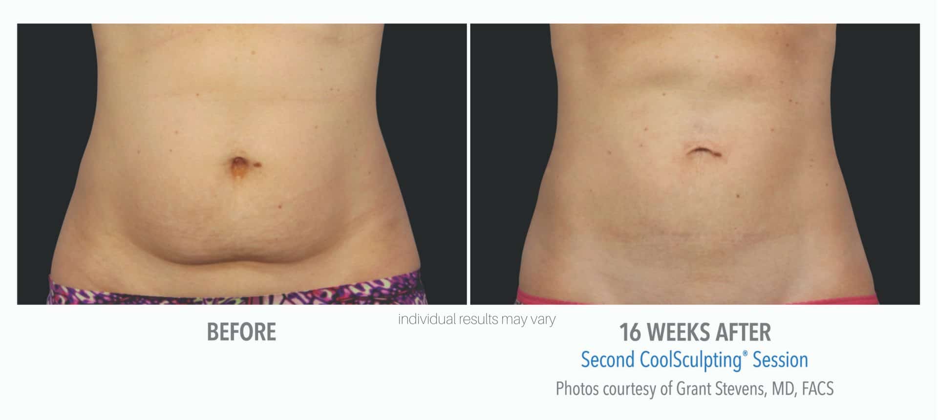 coolsculpting-before-and-after_1 coolsculpting-before-and-after_1