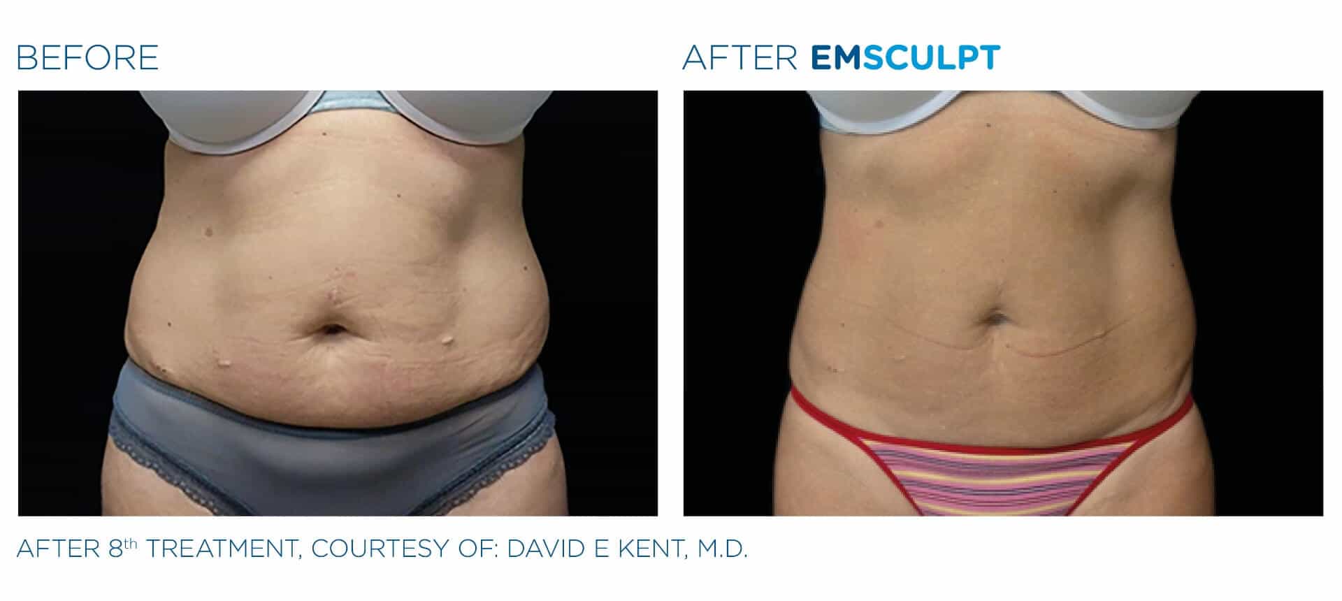 emsculpt_pic_ba-card-female-abdomen-034_enus100