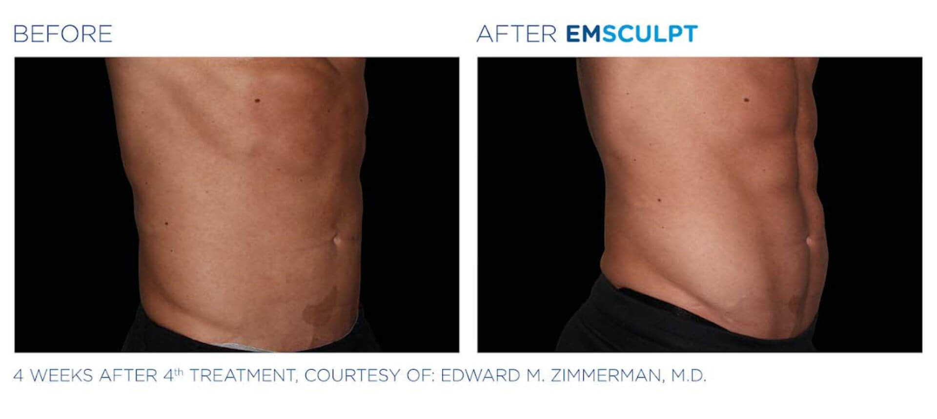Emsculpt Before and After Real Patient Results