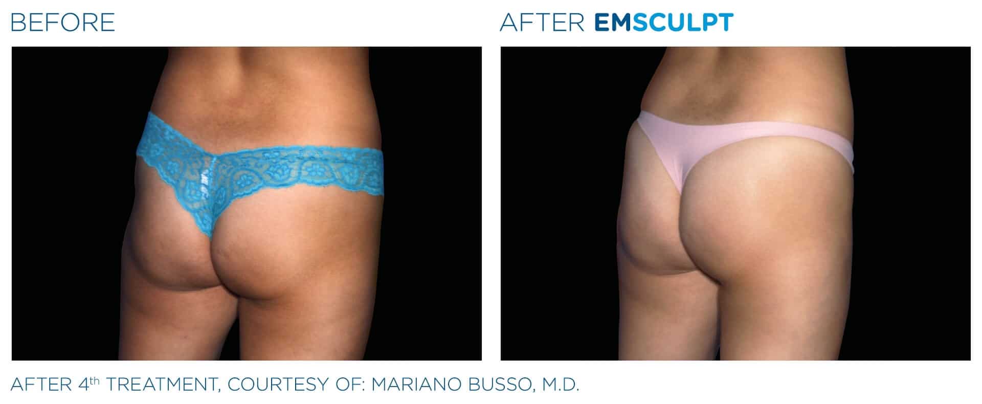 emsculpt butt lift before after