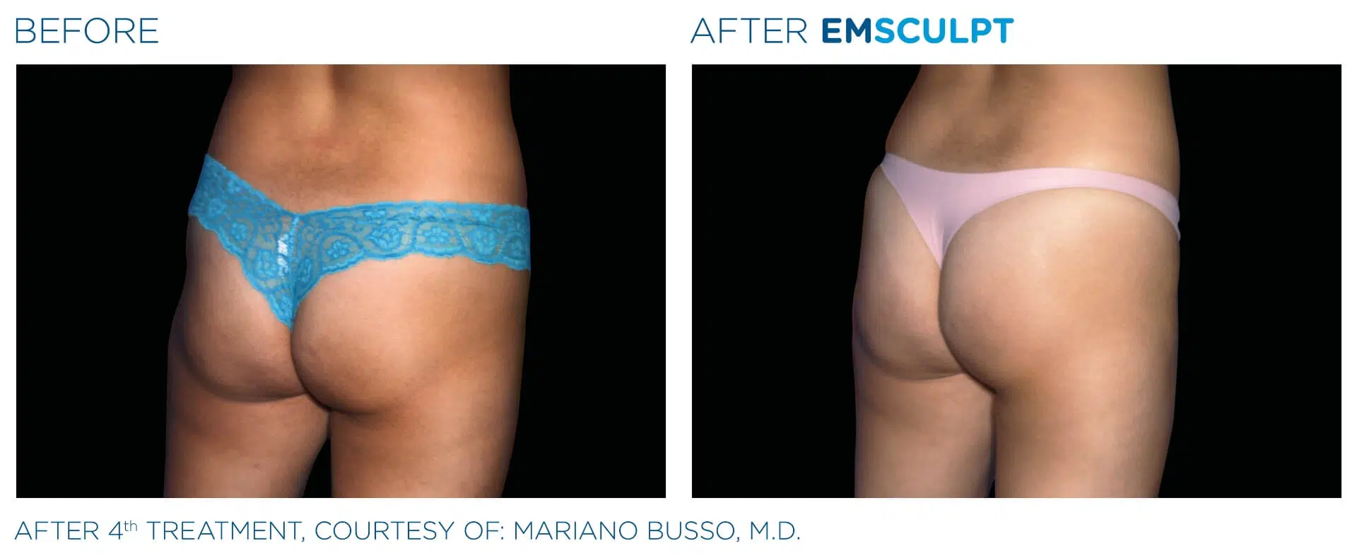 emsculpt butt lift before after