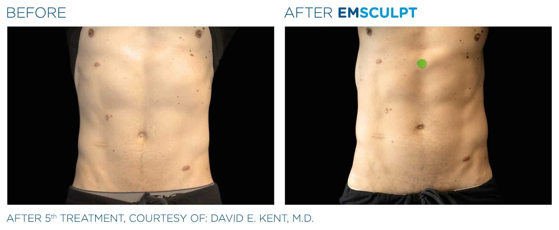 Before & After: Result of EMSculpt treatment in Paris