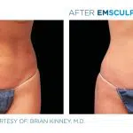 emsculpt before and after