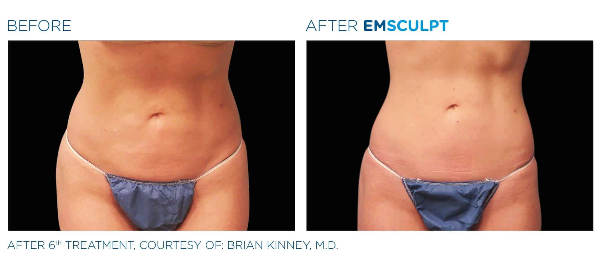 emsculpt before and after