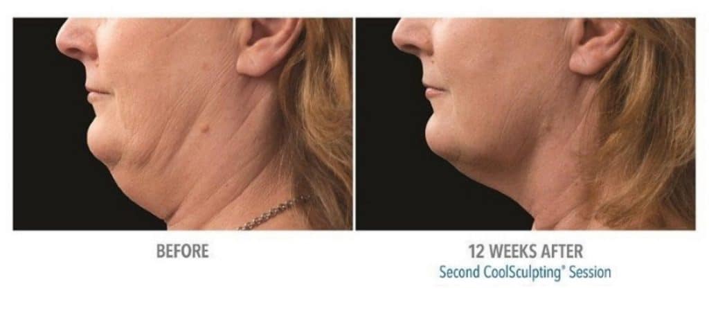 necbs-coolsculpting-before-after-1