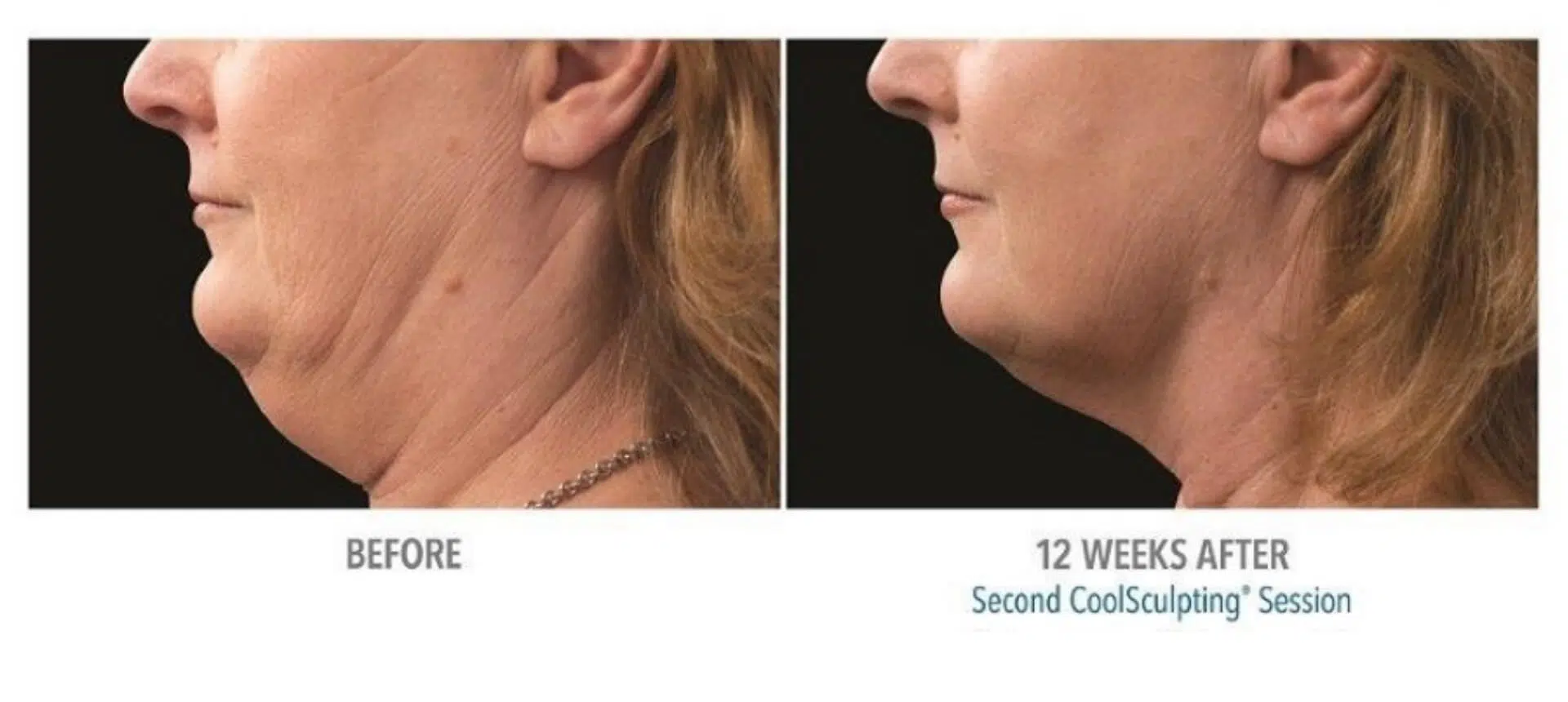 necbs-coolsculpting-before-after-1