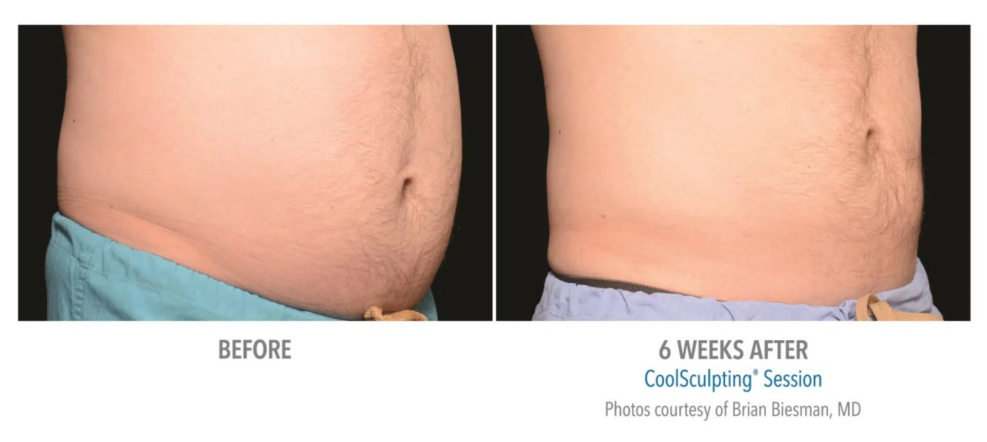 coolsculpting before and after for men stomach