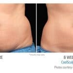 CoolSculpting before and after