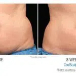 CoolSculpting before and after