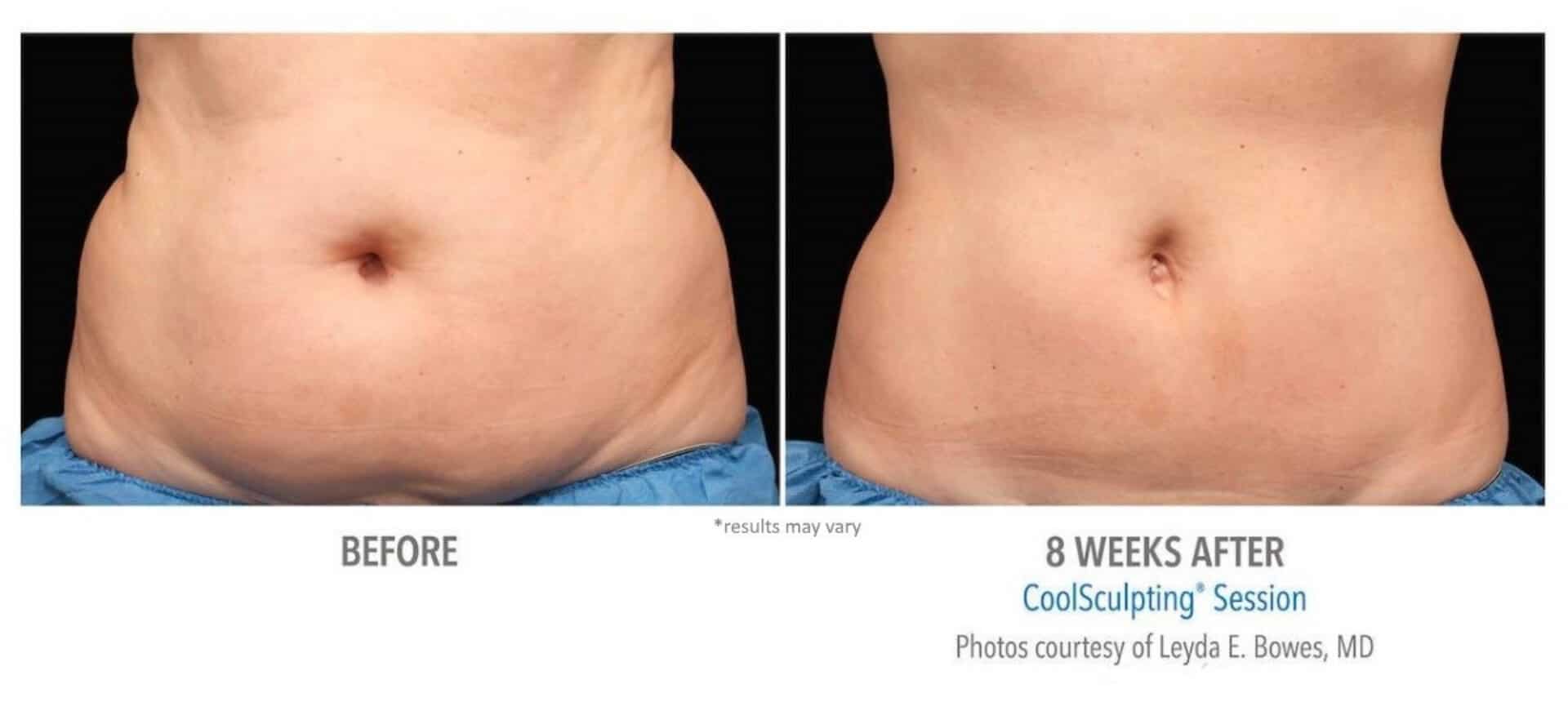 CoolSculpting before and after