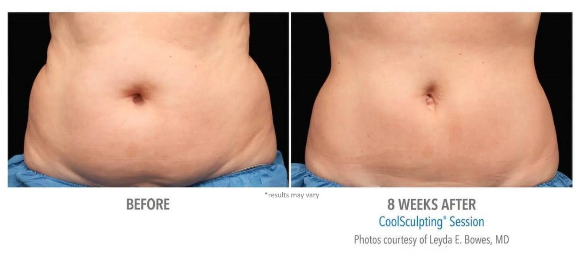 CoolSculpting before and after