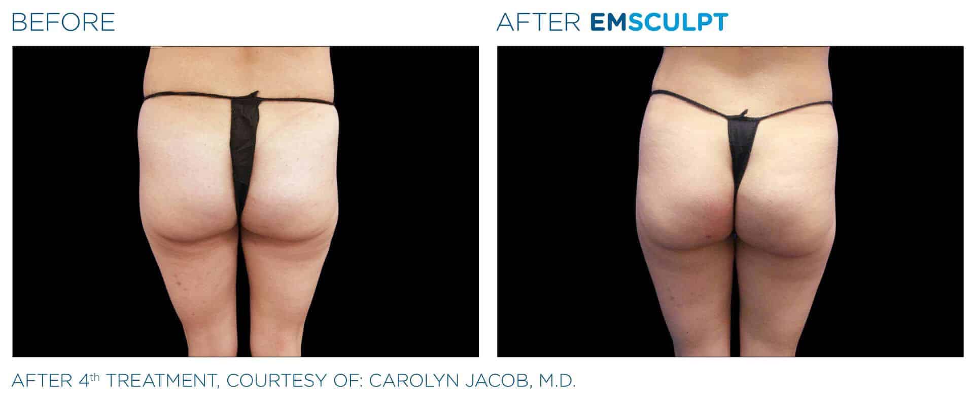 Before & After: Result of EMSculpt treatment in Paris