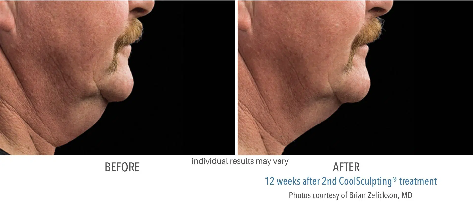 coolsculpting before and after male double chin