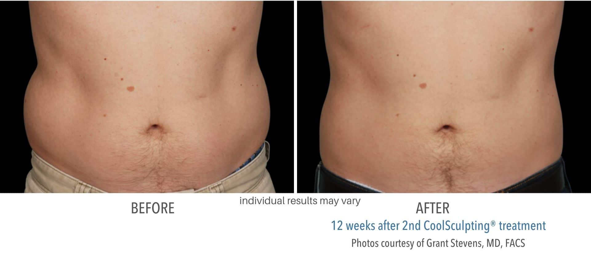 coolsculpting before and after male stomach