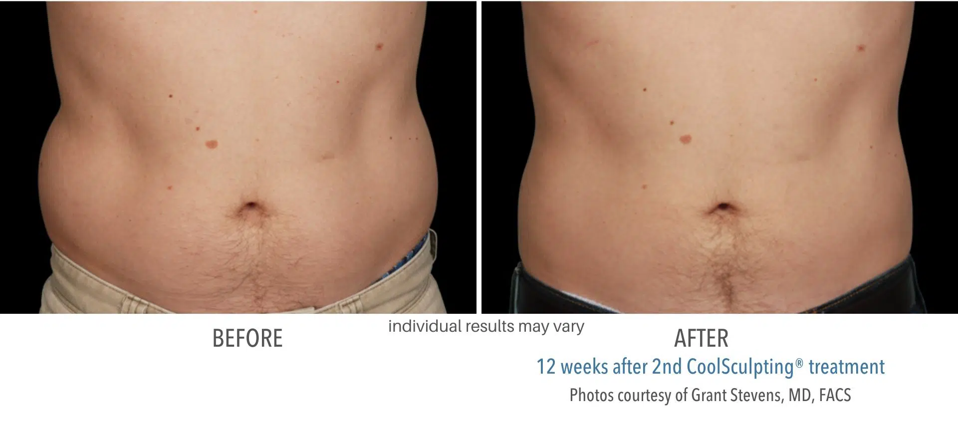 coolsculpting before and after male stomach