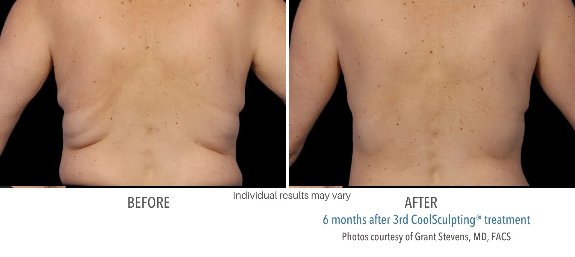 coolsculpting before and after back male