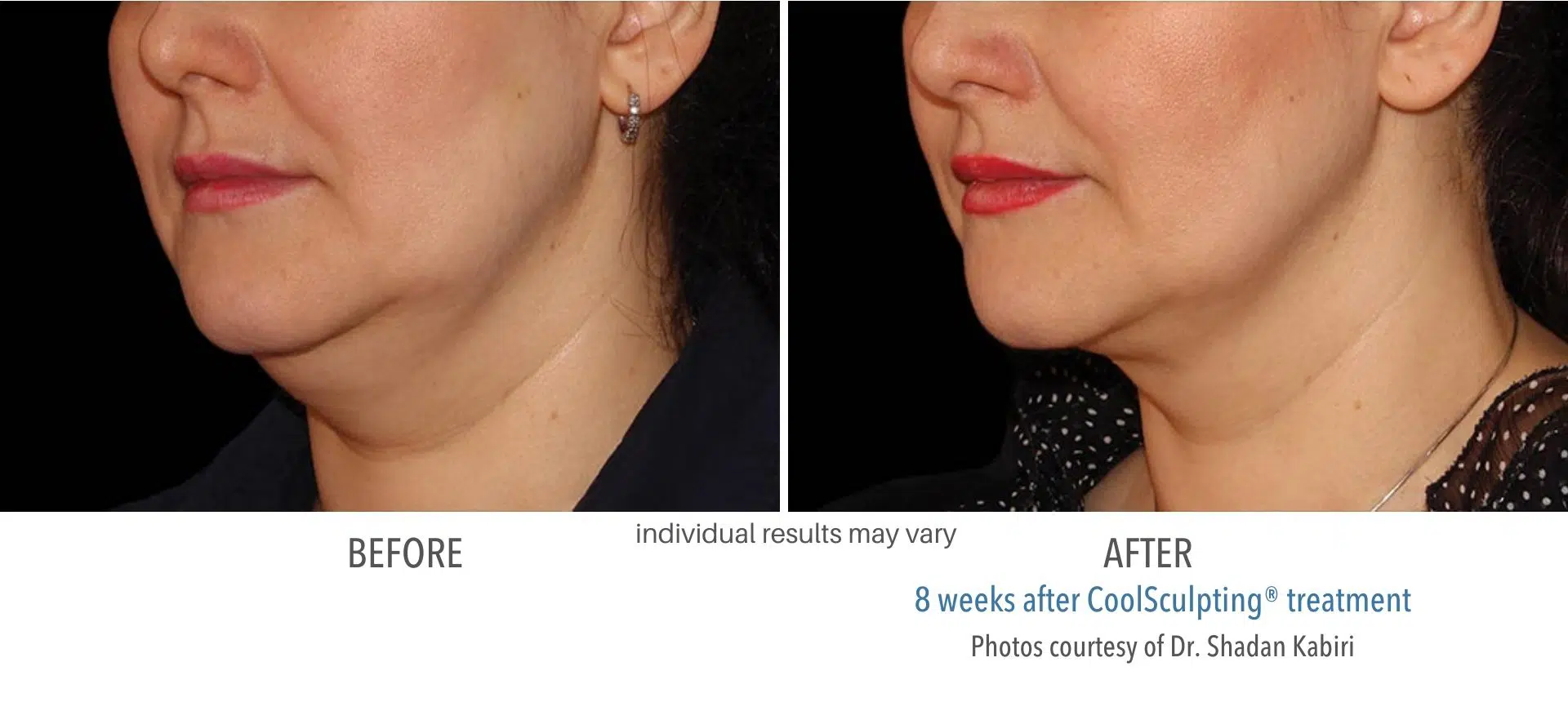 coolsculpting before and after double chin fat at Middleboro, MA