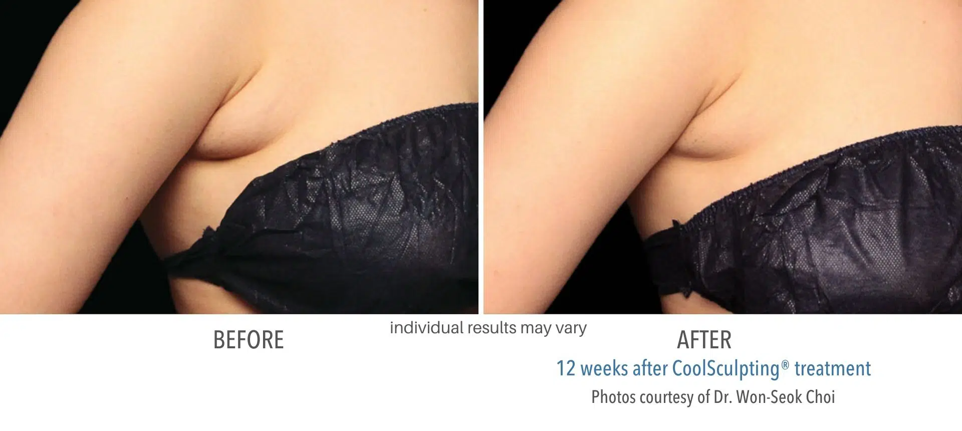 coolsculpting before and after armpit fat at Middleboro, MA