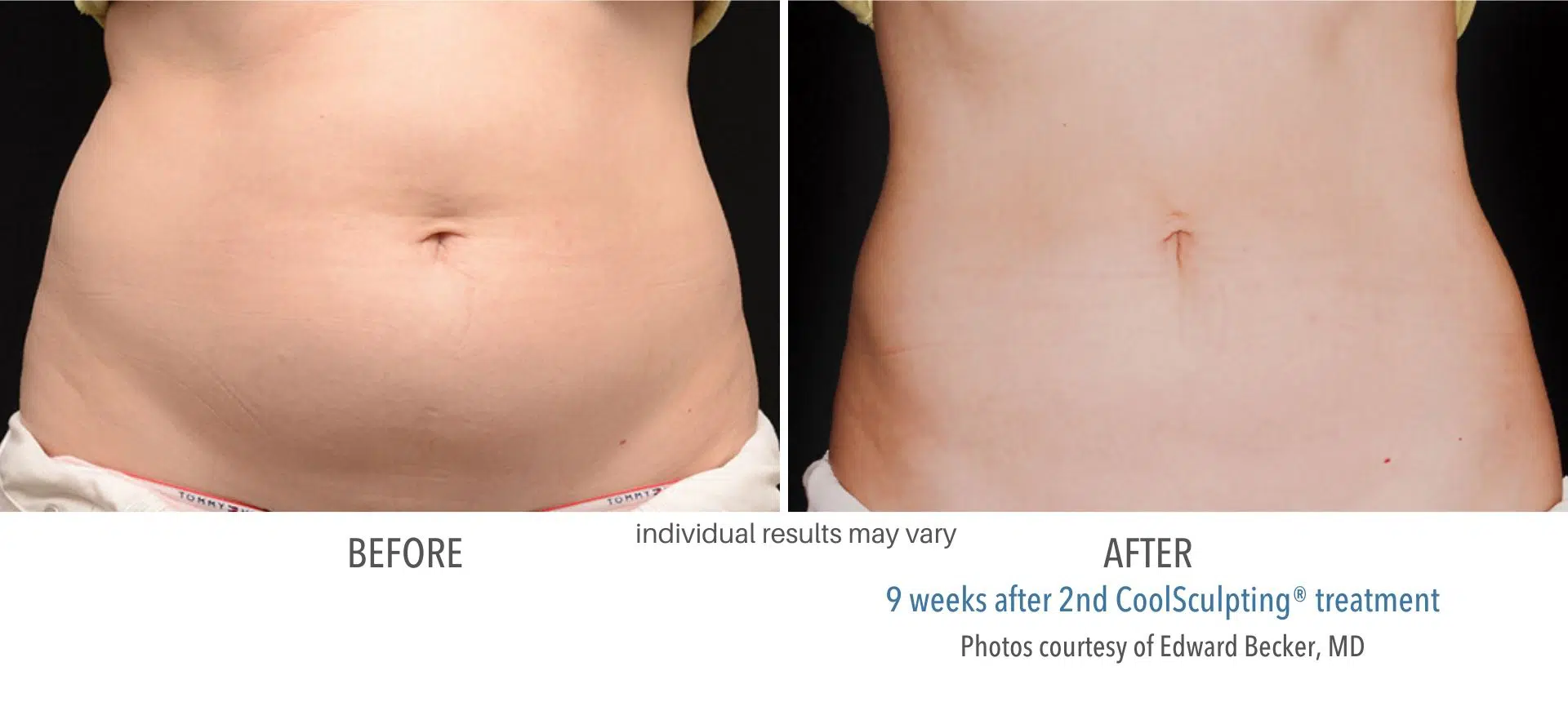 coolsculpting before and after belly fat at Middleboro, MA