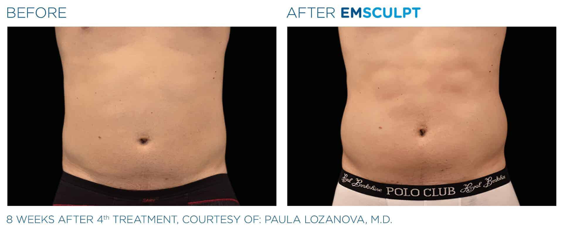 emsculpt-before-and-after-3-edited