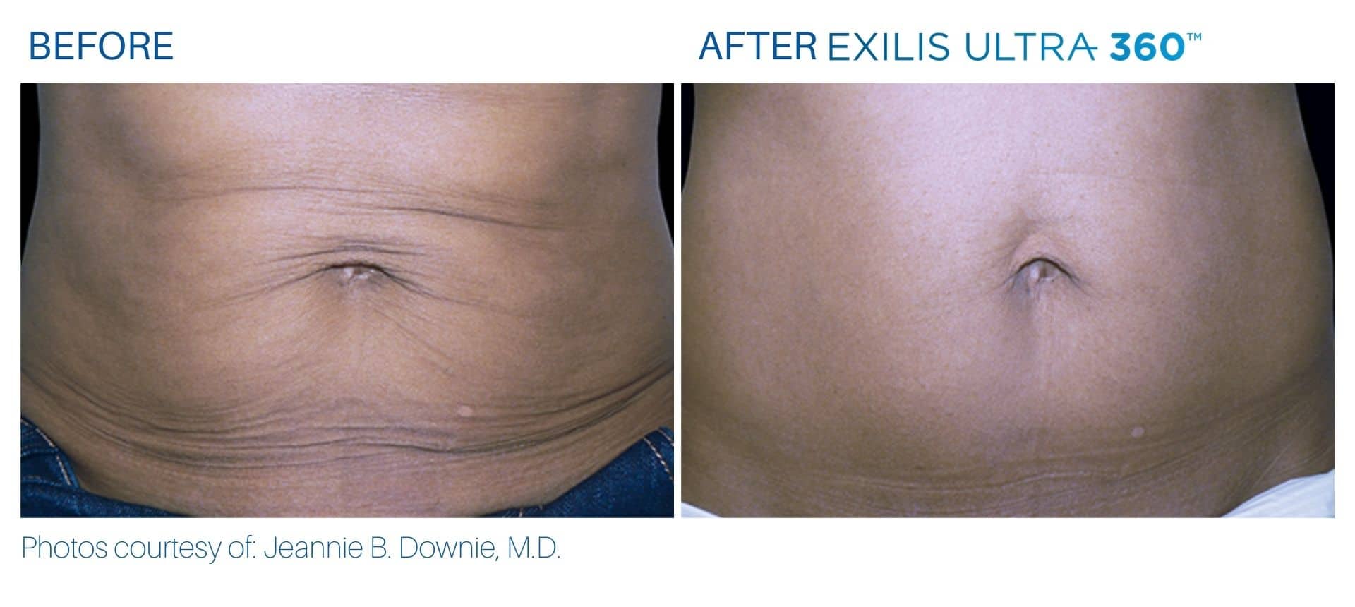 exilis for men