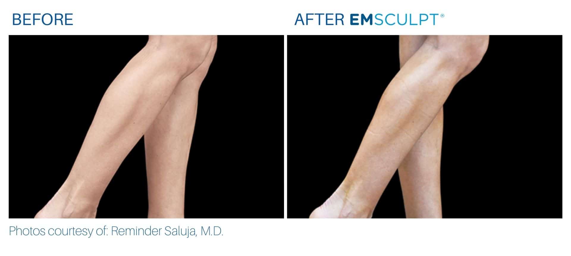 emsculpt calves treatment