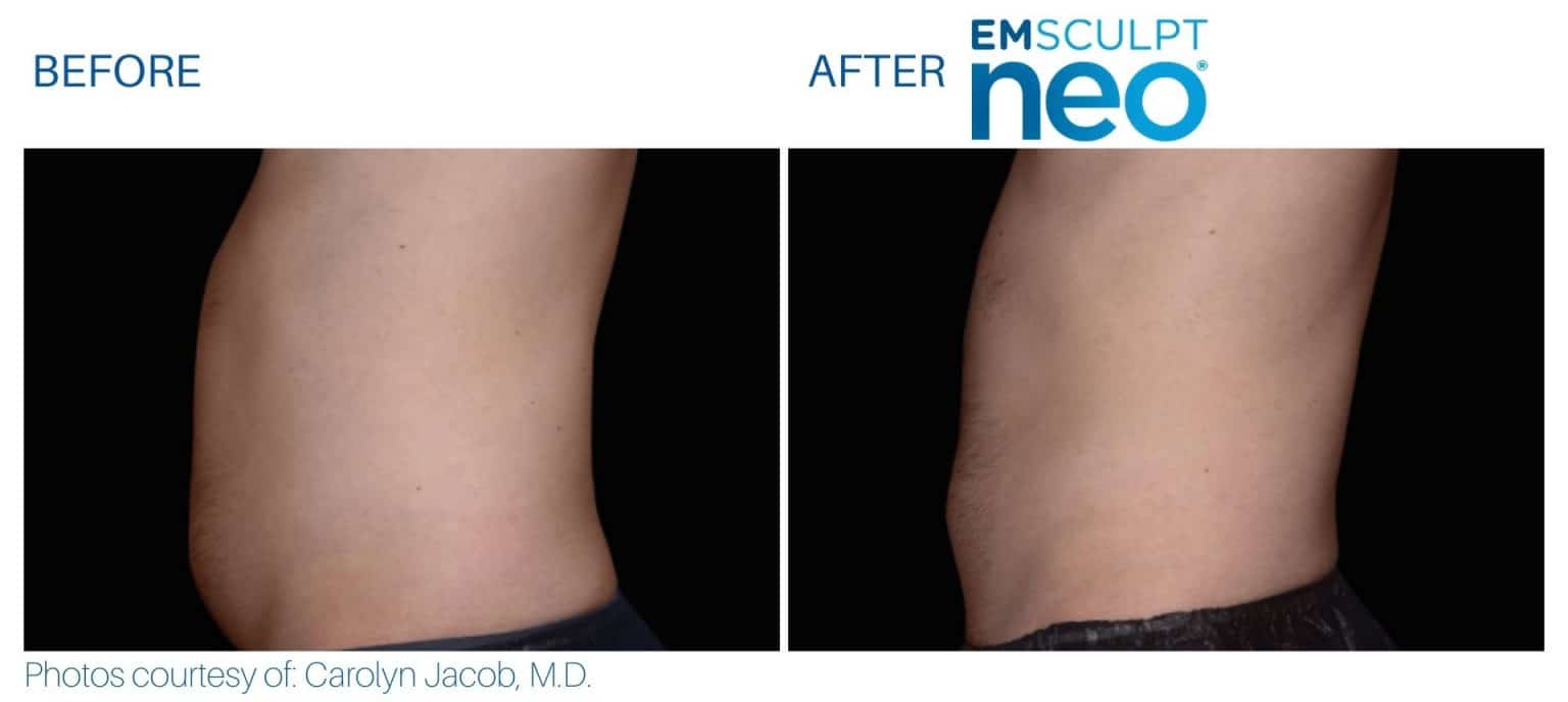 Emsculpt NEO Before and After Real Patient Results