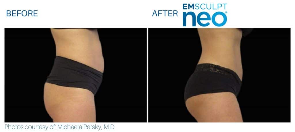 emsculpt neo Buttocks area at Middleboro, MA