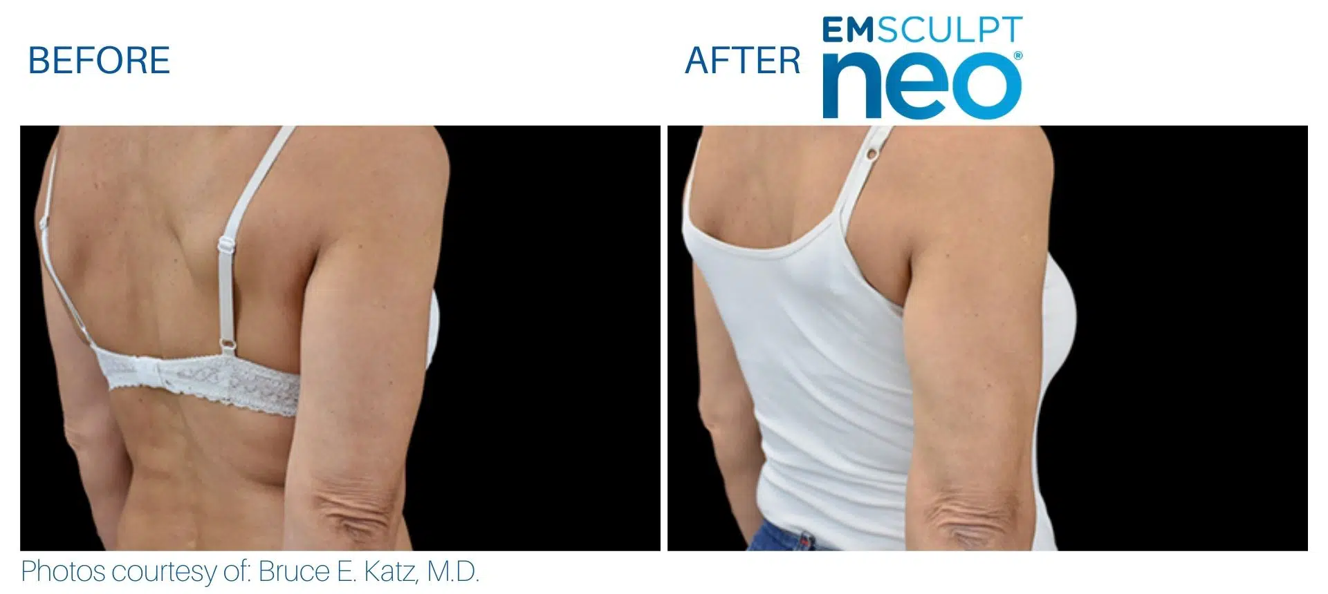 emsculpt neo Triceps women area at Middleboro, MA