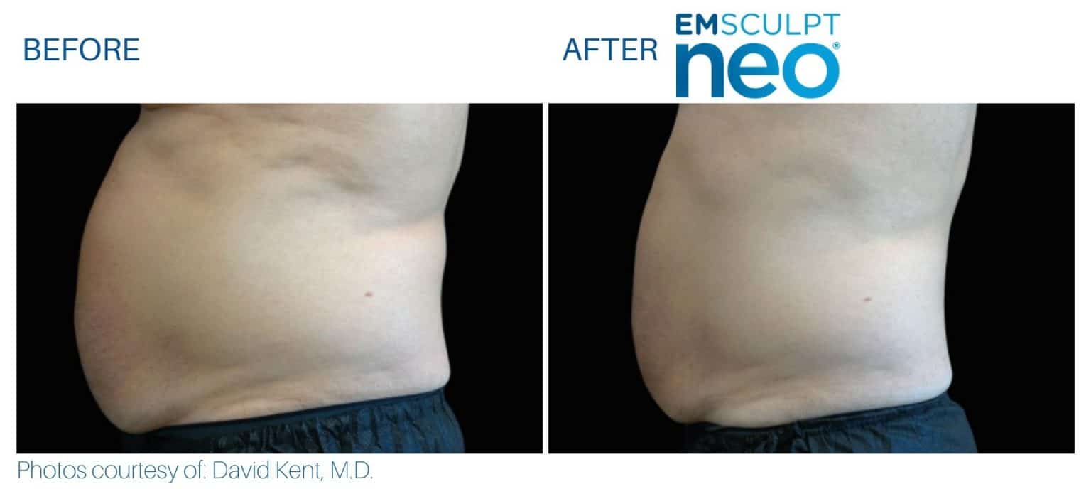 Emsculpt NEO Before and After Real Patient Results