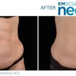 emsculpt neo abdomen treatment in New England Center for Body Sculpting