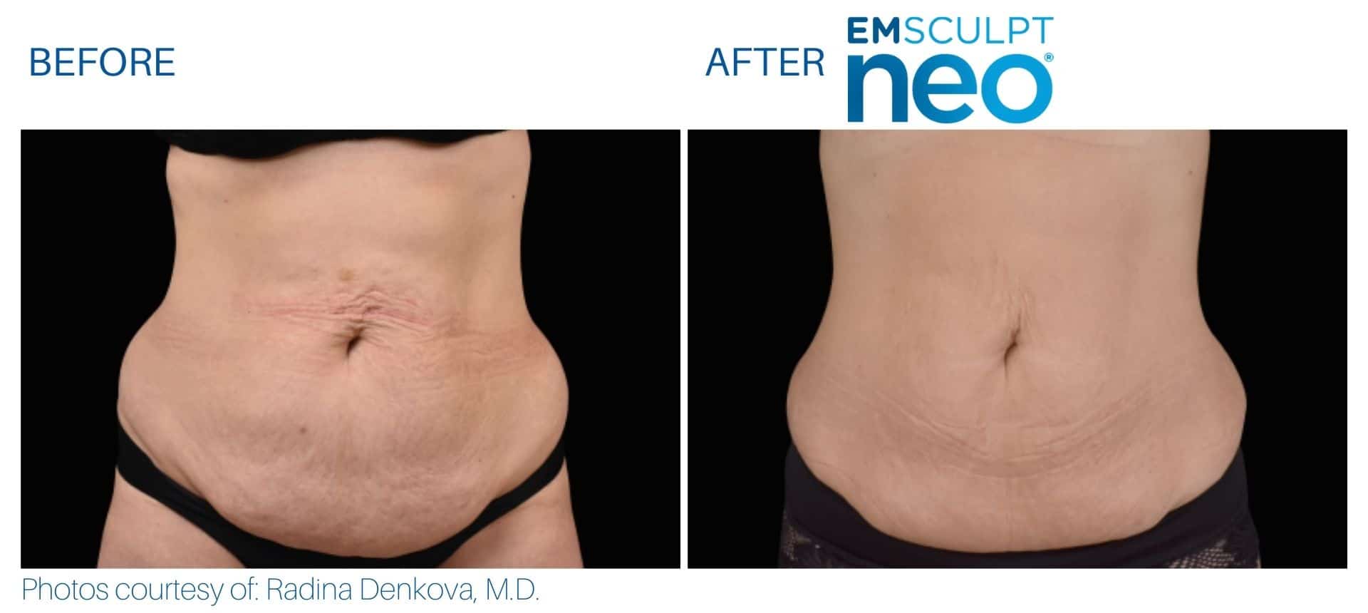 emsculpt neo abdomen treatment in New England Center for Body Sculpting
