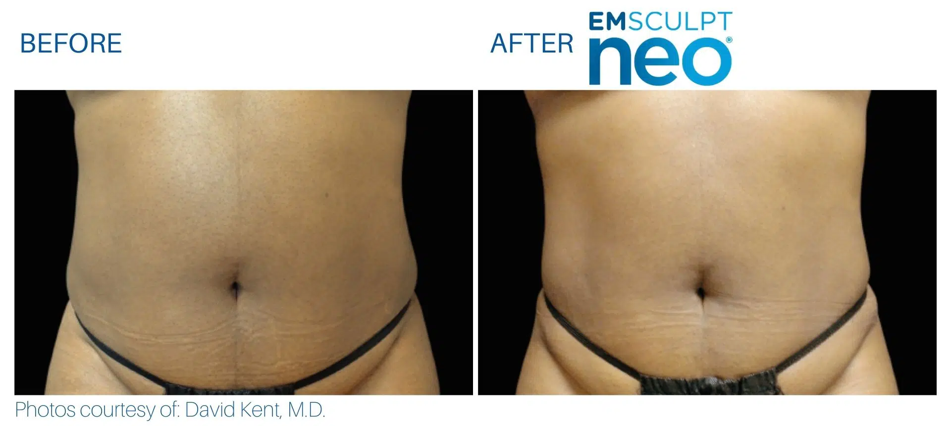 emsculpt neo abdomen for women treatment Julia Edelman MD