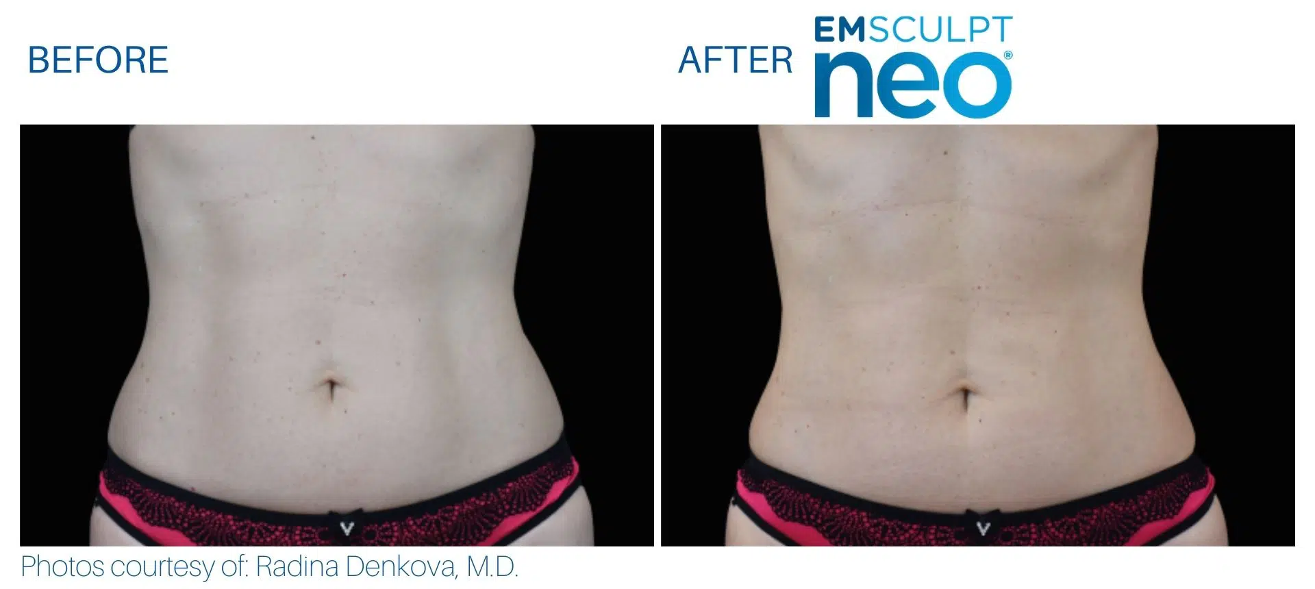 emsculpt neo abdomen treatment JuliaEdelman MD